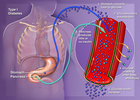 type 1 diabetes