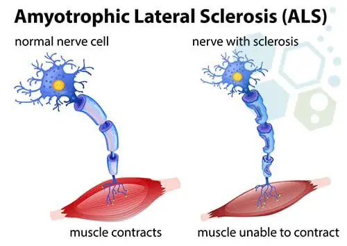 STem Cell Therapy for ALS